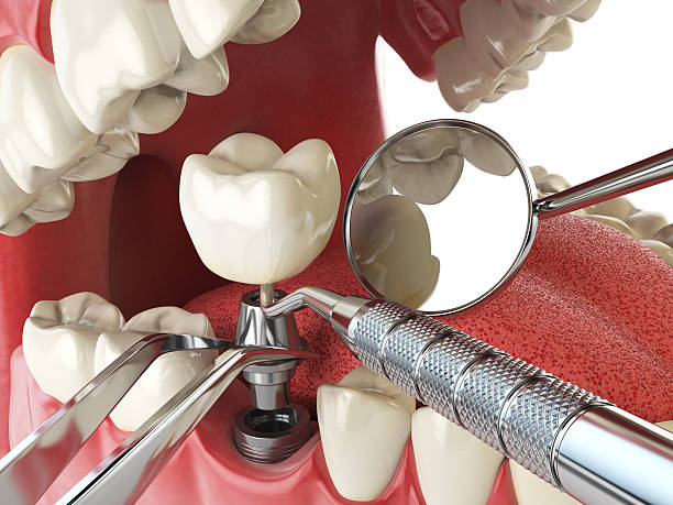 Best Knocked-Out Tooth (Avulsed Tooth) Treatment in Newcastle, WY
